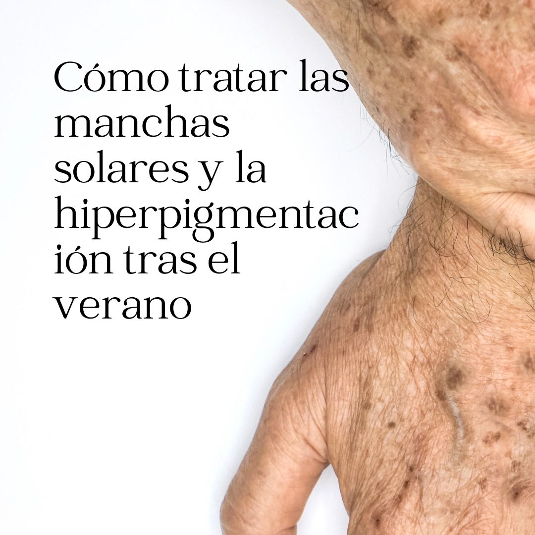 Cómo tratar las manchas solares y la hiperpigmentación tras el verano